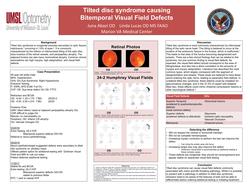 Tilted disc syndrome causing Bitemporal Visual Field Defects